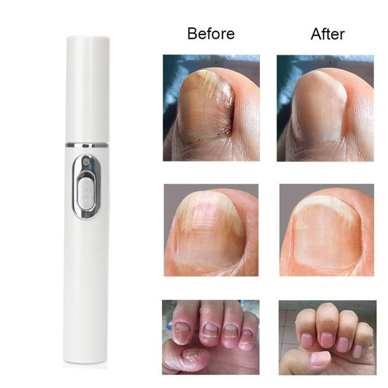 Laser Pen For Repairing Gray Nails